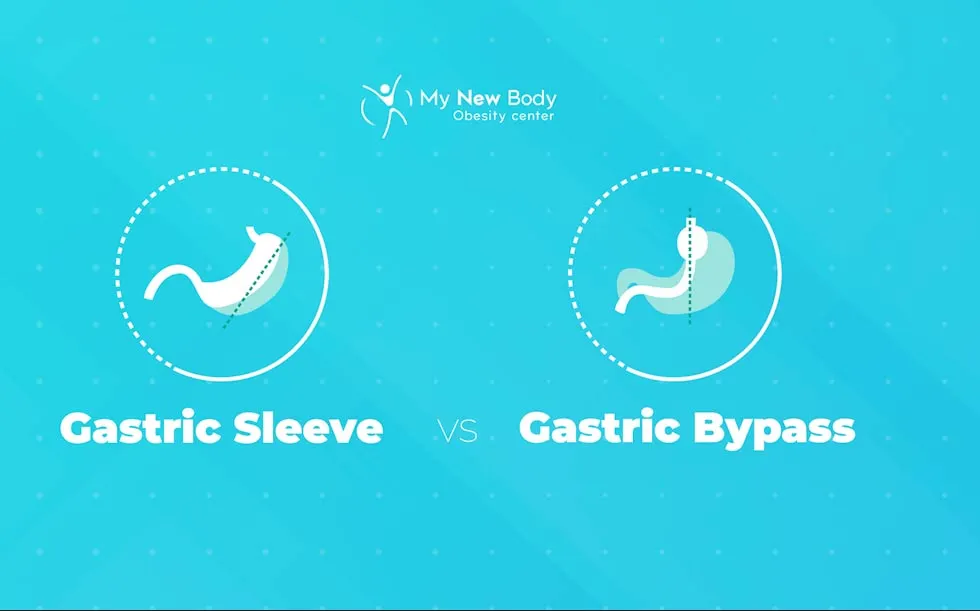 Gastric Sleeve Vs Gastric Bypass