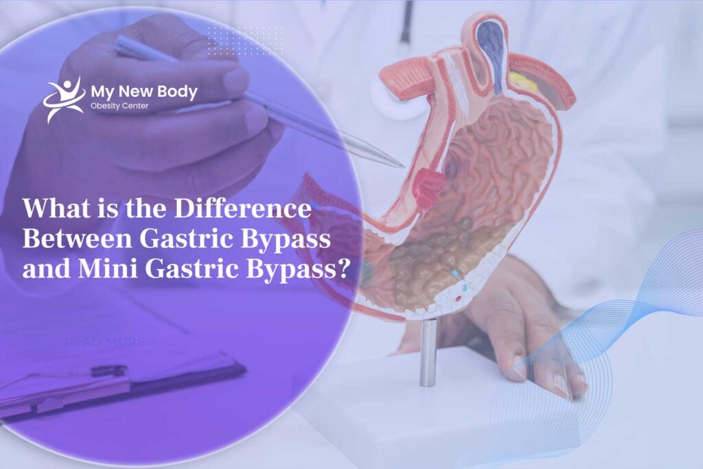 What is the difference between Mini Gastric Bypass and Gastric Bypass?